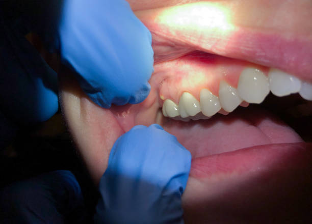 Best Emergency Wisdom Tooth Extraction in East Camden, SC
